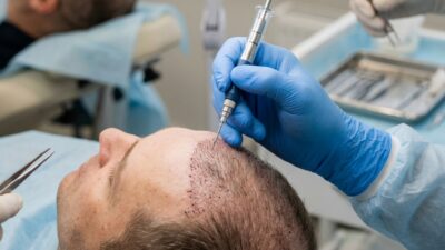 DHI (Direct Hair Implantation): чем отличается от FUE и кому она подходит